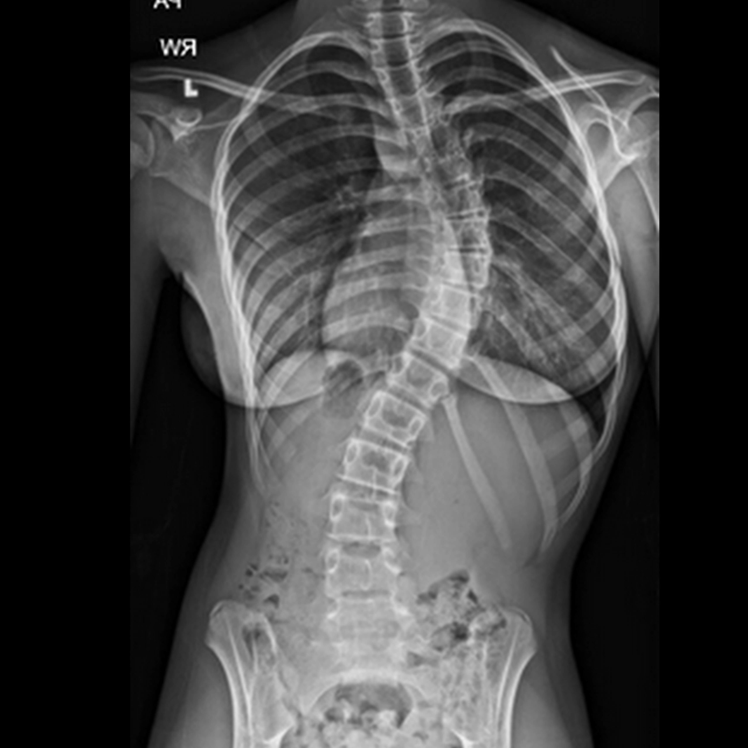 Scoliosis-x-ray-wide-scaled